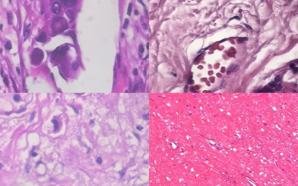 Cancer