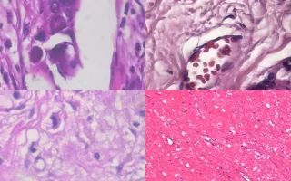 Cancer